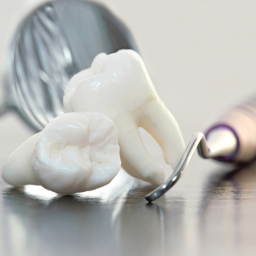 Décision d'extraire les dents de sagesse
