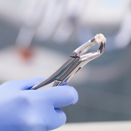 Précautions après extraction dentaire