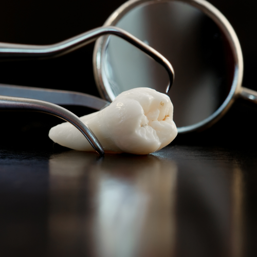 Éruption des dents de sagesse