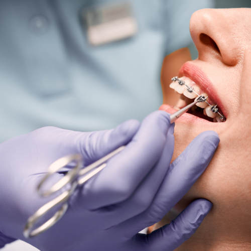Appareil orthodontique en place