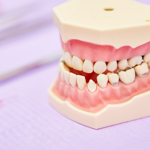 Malocclusion dentaire