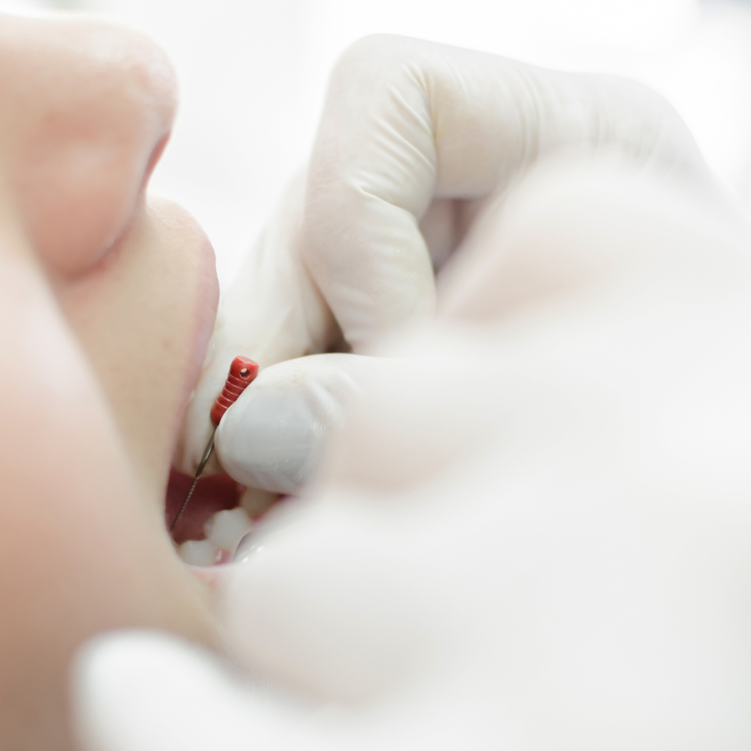 Indications de la dévitalisation dentaire