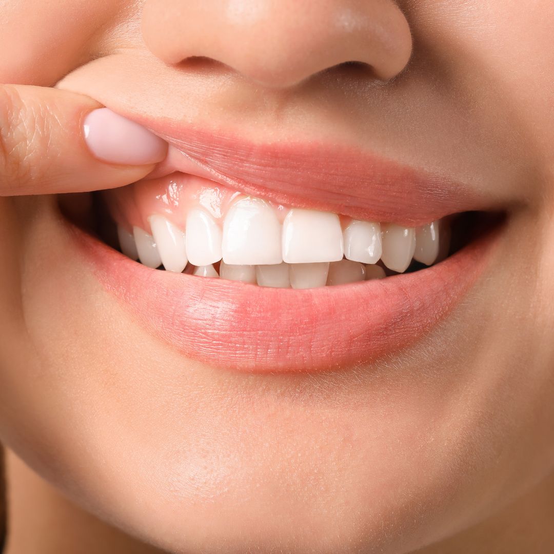 Greffe gingivale : indications et déroulement