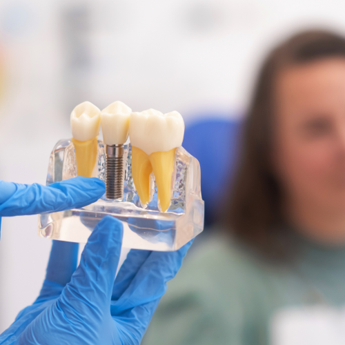 Implant dentaire en titane