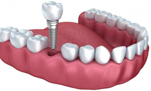 Couronne vs implant : explication