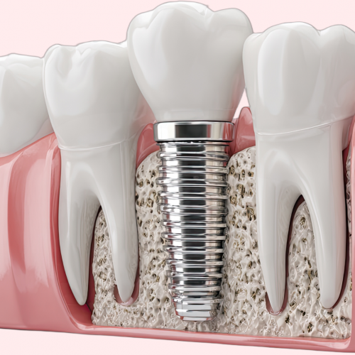 Durée de vie d'un implant dentaire