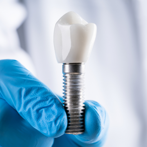 Questions fréquentes sur les implants dentaires
