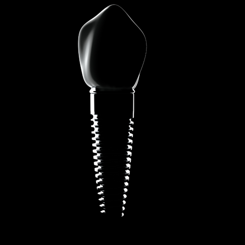 Implant ou facette : différence