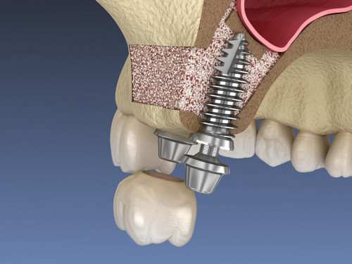 Sinus lift : préparation à l'implant